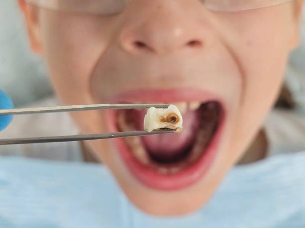 Best Emergency Dentist for Lost Fillings or Crowns in Greensburg, PA